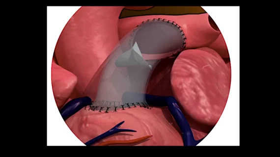 MASA Valve PECA Labs polymeric pulmonary valve Children’s Hospital of Philadelphia. The MASA Valve is a polymeric pulmonary valve designed and manufactured by Pennsylvania-based PECA Labs. It features a proprietary bi-leaflet design and was designed to grow with the patient, limiting the need for repeat surgeries. While the MASA Valve is not yet fully approved by the U.S. Food and Drug Administration (FDA), it has received the agency’s humanitarian use device and investigation device exemptions. 