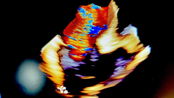 Mitral valve with regurgitation 3D ICE Siemens ICE at #ASE2023.