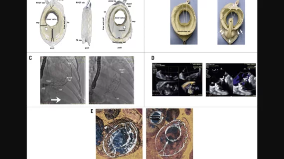 VDyne Valve for transcatheter tricuspid valve replacement