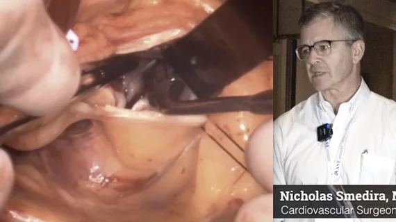 Photo of a surgical cardiac septal myectomy to treat hypertrophic cardiomyopathy (HCM). Nicholas Smedira MD discusses septal myectomy in HCM patients and the need for more detailed protocols for HCM care. #HCM #ASE #ASE2023 #myectomy