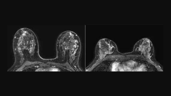  background parenchyma enhancement breast MRI