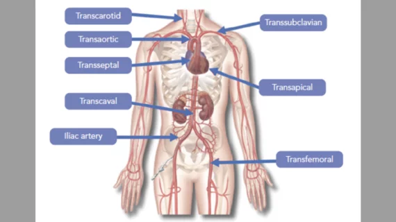 Alternative access approaches for transcatheter aortic valve replacement (TAVR) procedures. courtesy of Interventional Cardiology Review 2018;13(3):145–50.