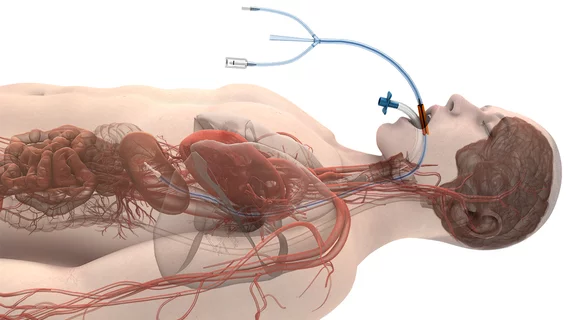 Attune Medical has been granted De Novo marketing authorization from the US Food and Drug Administration (FDA) for its ensoETM device to reduce the likelihood of ablation-related esophageal injury resulting from radiofrequency cardiac ablation procedures.