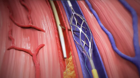 LimFlow, a medical device company with locations in California and Paris, has gained approval from the U.S. Food and Drug Administration (FDA) for its LimFlow System for Transcatheter Arterialization of Deep Veins. The LimFlow System was designed to help reestablish blood flow in chronic limb-threatening ischemia (CLTI) patients who face a high risk of amputation and have no other endovascular or surgical options available to them.