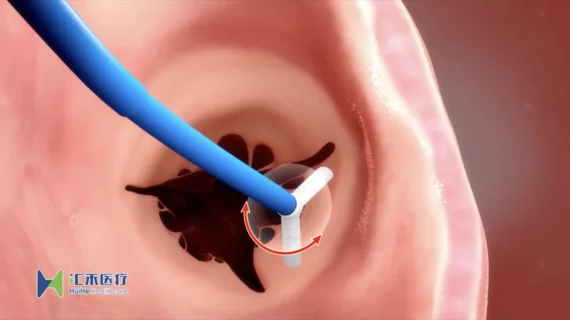 K-Clip Transvascular Tricuspid Repair System from Huihe Healthcare