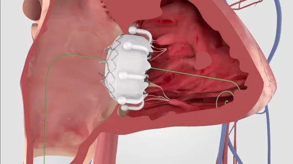 Edwards Evoque transcatheter tricuspid valve replacement TTVR