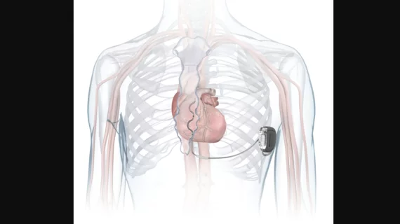 Medtronic extravascular ICD Aurora EV-ICD MRI SureScan