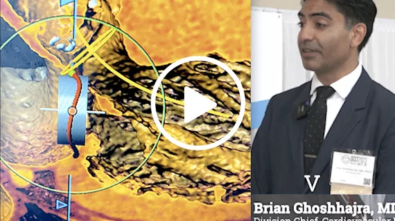 Video of Brian Ghoshhajra, MD, Mass General, explaining some of the top trends in cardiac CT from SCCT 2023 meeting. #SCCT #SCCT23 #SCCT2023 #YesCCT