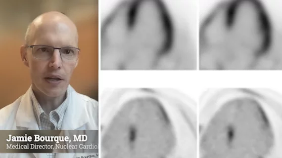 Jamie Bourque, MD, discusses fluorodeoxyglucose (FDG) and its growing use cases in cardiac PET imaging He discussed the radiotracer in sessions at ASNC 2023. #ASNC #ASNC23 #ASNC2023