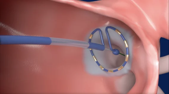 Medtronic's PulseSelect Pulse Field Ablation (PFA) System 