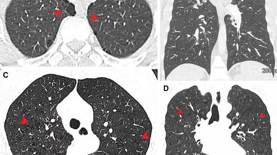 Lung damage from study