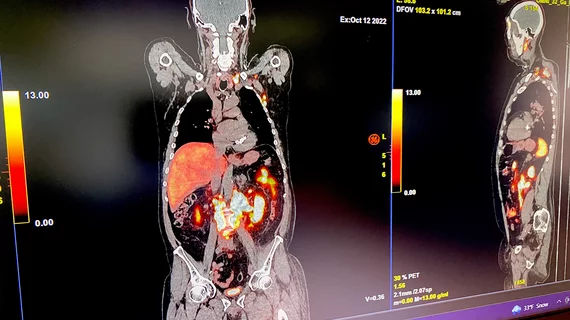 PSMA PET CT scan with prostate cancer metastasis GE RSNA23 DF