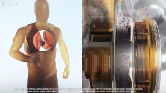 BiVACOR Total Artificial Heart. BiVACOR, an international medical device company with headquarters in the United States and Australia, has received approval from the U.S. Food and Drug Administration (FDA) to kick off an early feasibility study (EFS) for its total artificial heart (TAH) technology. 