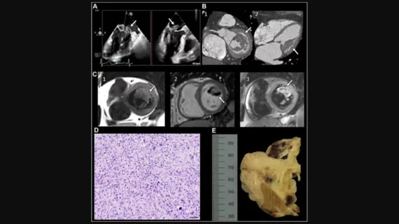 “Undifferentiated Cardiac Sarcoma of the Mitral Valve: Multimodal Imaging Assessment" Radiology: Cardiothoracic Imaging RSNA 