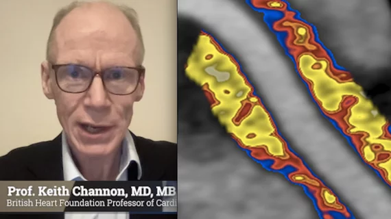 Professor Keith Channon, MD, MB ChB, FRCP, interventional cardiologist and the British Heart Foundation Professor Cardiovascular Medicine at the University of Oxford, and a co-founder of Caristo, explained an AHA 2023 study where AI identified coronary inflammation as a major silent risk factor and a strong predictor of heart attack risk.