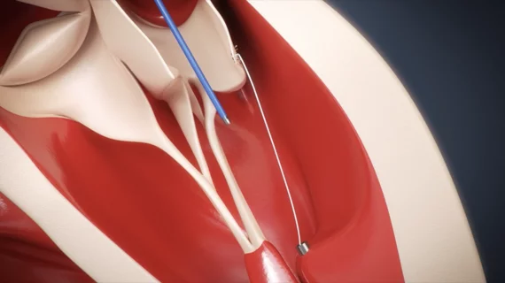 CardioMech mitral valve repair from CardioMech AS, a Norway-based medical device company focused on structural heart disease, has raised $13 million. This new funding is expected to go toward the continued development of CardioMech’s transcatheter mitral valve repair offering for patients presenting with degenerative mitral regurgitation (MR).