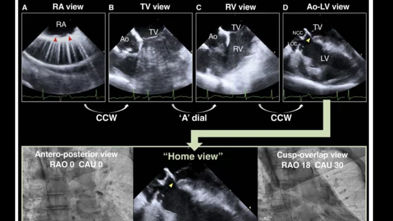 Self-expandable TAVR cusp-overlap ICE