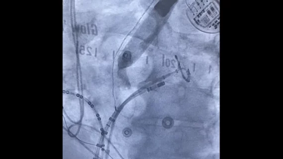 Example of the Esolution device developed by S4 Medical being used during a radiofrequency ablation procedure. Image courtesy of Daoud et al.