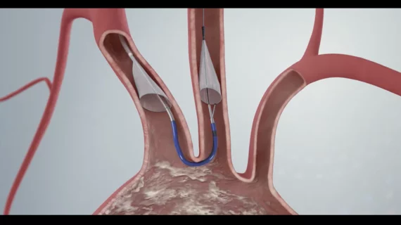 Using the Sentinel cerebral protection device during valve-in-valve TAVR is associated with significant clinical improvements. 