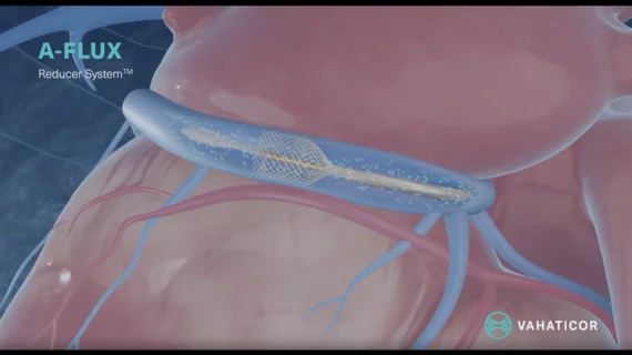 Image of the A-FLUX Reducer System for chest pain by VahatiCor 