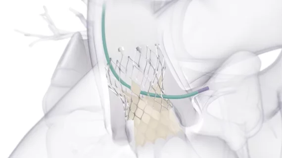 Medtronic's Evolut Pro TAVR valve treating aortic stenosis