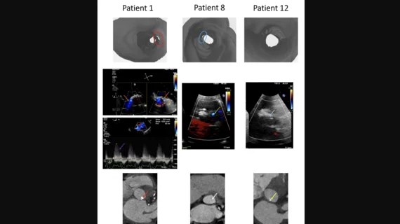 Virtual reality (VR) can help cardiologists plan for transcatheter aortic valve replacement (TAVR) procedures and predict the presence and severity of post-TAVR paravalvular leak (PVL), according to new research published in the Journal of Invasive Cardiology.[1]