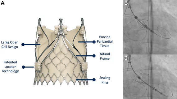 TAVR JenaValve Trilogy Heart Valve System pure AR 