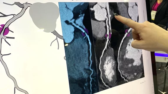 Heartflow Roadmap AI can show the locations and severity of coronary lesions from a CT scan to act as a second set of eyes for imagers, and to better inform referring physicians and patients.