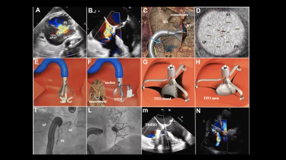 An 86-year-old patient is showing signs of improvement six months after receiving the world’s first implant of a new-look medical device for treating tricuspid regurgitation (TR), according to new data published in JACC: Cardiovascular Interventions.[1] The device in question, the Tricuspid Flow Optimizer, was developed by Triflo Cardiovascular, a U.S.-based biomedical company founded in 2017 by a team of structural heart specialists. 