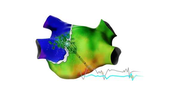 The Carto 3 System Version 8, includes new modules designed to improve efficiency in addition to advanced artificial intelligence (AI) algorithms. The new modules included in this update are CartoSound FAM, which automatically generates a model of patient’s left atrial anatomy before users insert a catheter into their left atrium, and Carto Elevate, which helps electrophysiologists by making the activation maps more accurate and tracking atrial fibrillation (AFib) burden before and after ablation.