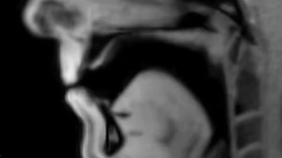 live MRI video of stuttering