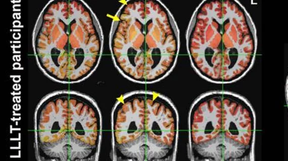 light therapy improves brain connectivity after head trauma