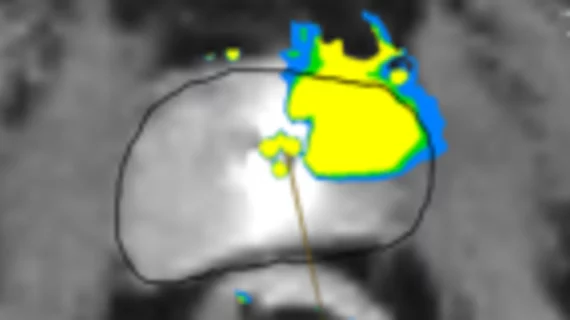 Profound Medical prostate ablation contouring assistant