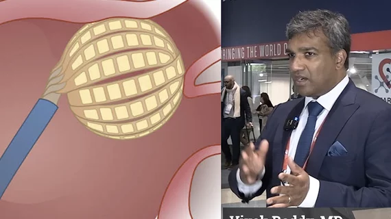 Vivek Reddy, MD, Director, Cardiac Arrhythmia Service, and the Leona M. and Harry B. Helmsley Charitable Trust Professor of Medicine in Cardiac Electrophysiology, at Mount Sinai in New York, was involved in most of the late-breaking pulsed field ablation (PFA) trials at the Heart Rhythm Society (HRS) 2024 meeting. He offers an overview of the new data presented and his observations from using PFA. #HRS24 #HRS2024 #PFA #EPeeps