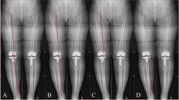 AI can accurately complete leg length and angular measurements