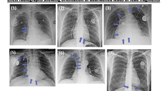 Some of the abandoned leads and various shapes and positions of the wires from the study. None of these patients had any safety issues related the abandoned leads. Image courtesy of RSNA