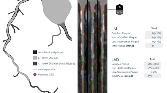 HeartFlow introduced its next generation artificial intelligence (AI) Plaque Analysis with an interactive experience at SCCT 2024. It shows a 3D plaque model and analysis by territory across calcified, non-calcified and low-attenuation plaques. This includes viewing cross-sectional, color-coded images of each plaque type where it was quantified along the vessel. #SCCT #SCCT24 #SCCT2024