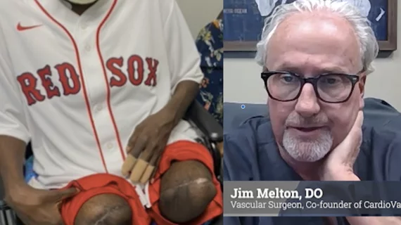 Video interview with Jim Melton, DO, vascular surgeon, explains the CLI mortality rate among amputees in rural Oklahoma, and the need for outreach programs to screen more patients.