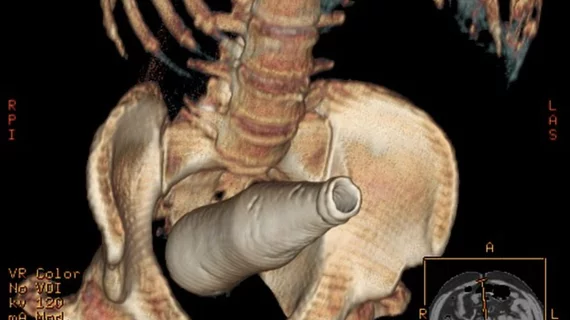 CT scan of a Coca-Cola bottle rectal foreign body. There are a sizable number of emergency room cases each year for items people insert into their rectums that become lodged or lost inside the colon. This includes many types of household items beyond vibrators and commercially made butt plugs. Ghonaim E, Rectal foreign body. Case study, Radiopaedia.org. Butt plug sex toy inserted into rectum.