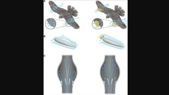 StreamlineValve self-cleaning TAVR valve inspired by nature. In a regular valve, abnormal flow and stagnation zones are prone to thrombosis (left). In the flow-controlled valve, taking an idea from bird's wings, a small volume of the blood flow is redirected to reduce stagnation zones as well as modulate the flow profile to be less turbulent and overall reducing flow-related thrombosis (right) Image/captions courtesy of European Heart Journal.