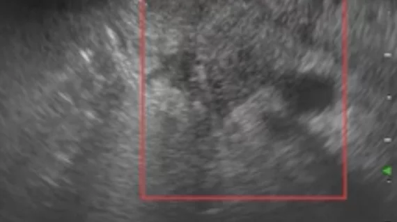 AI helps identify malignant/benign pancreatic lesions