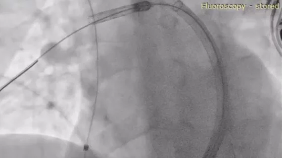 Restore Medical ContraBand medical device heart failure