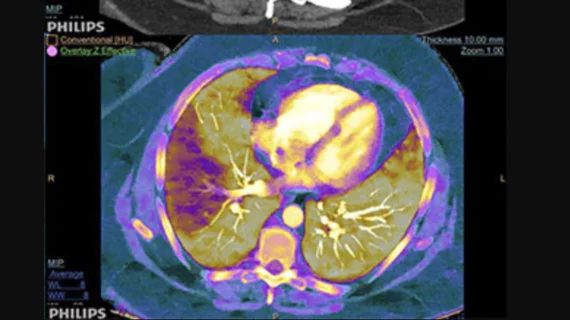 Example of spectral, or dual-energy CT, confirming a pulmonary embolism (PE). Image courtesy of Philips Healthcare