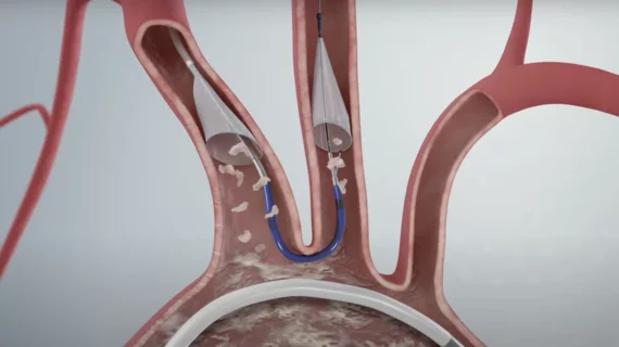 Boston Scientific's Sentinel Cerebral Protection System during a TAVR procedure