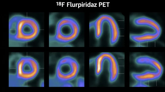 The new cardiac PET radiotracer flurpiridaz F-18 is posed to be a major game changer and will likely lead to increased adoption of cardiac PET.