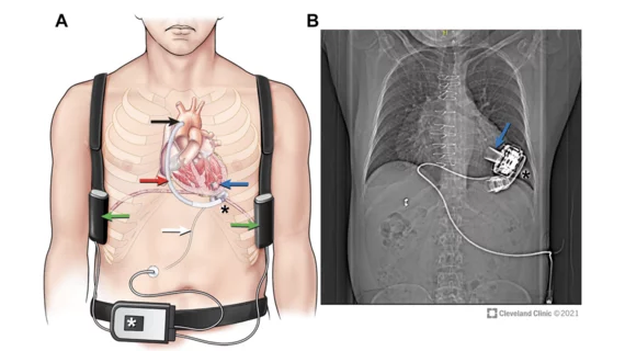 The American Society of Echocardiography (ASE) has shared new recommendations for performing medical imaging exams on heart failure patients with surgically implanted left ventricular assist devices (LVADs) and temporary mechanical circulatory support (TMCS) devices. The guideline, published in full in the Journal of the American Society of Echocardiography, represents ASE’s first update on the topic since 2015.[1] 