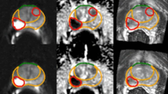 AI prostate lesion segmentation algorithm