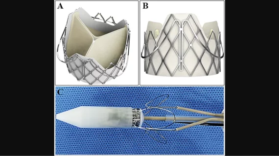 Performing transcatheter aortic valve replacement (TAVR) with the J-Valve transcatheter heart valve (THV) may help limit the risk of coronary artery obstruction (CAO) in high-risk patients, according to a new study published in Clinical Interventions in Aging.[1]