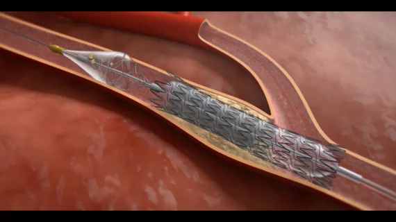 Contego Medical, a North Carolina-based medical device company, has received U.S. Food and Drug Administration (FDA) approval for its new all-in-one carotid stenting offering, the Neuroguard IEP System