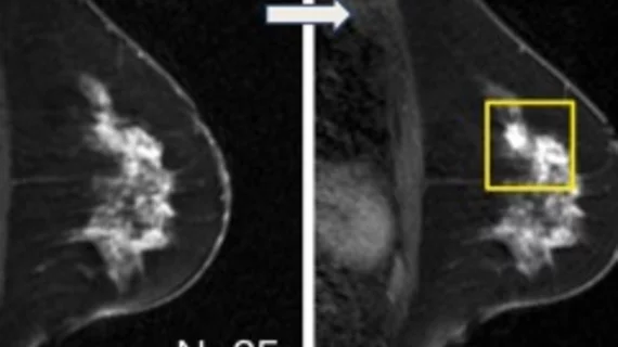 AI model spots missed breast cancers on MRI